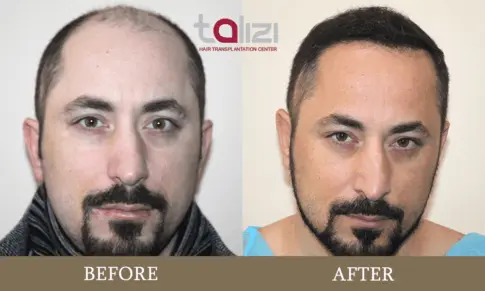 alopecia treatment - hair transplant before-after results of Gurami
