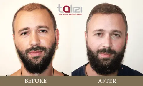 before after hair transplantation results of Vladimer