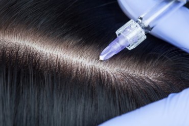 Hair transplantation method mesotherapy
