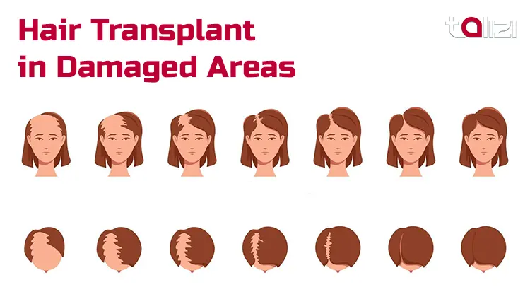 Hair transplant in scars and postburn areas