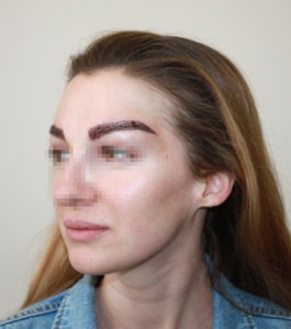 hair clinic talizi eyebrow transplant surgery result