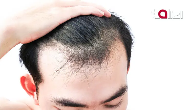 Alopecia: How to avoid hair loss disease