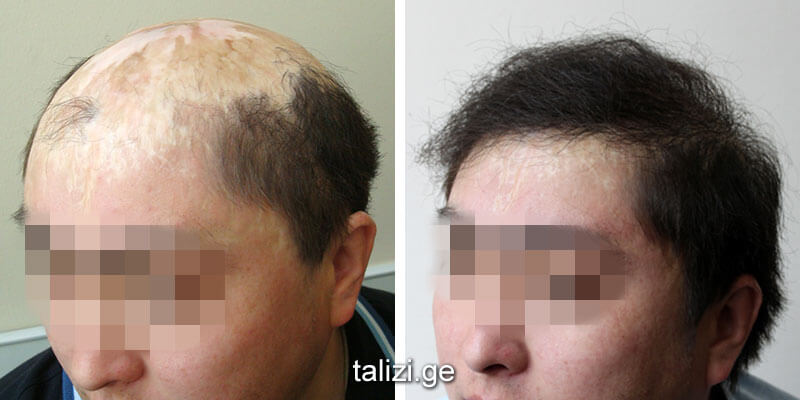 men hair cure of postburn scars