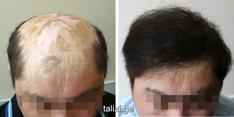growing hair in scars by transplantation