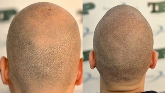 hair transplant ser=rvice of Talizi - tricopigmentation in scars -