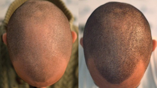 Hair transplantation Method - tricopigmentation