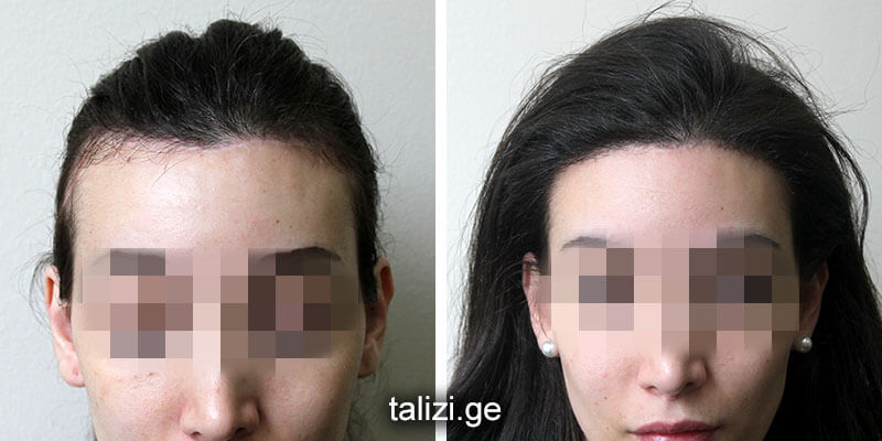 women hair regrow in damaged hairline