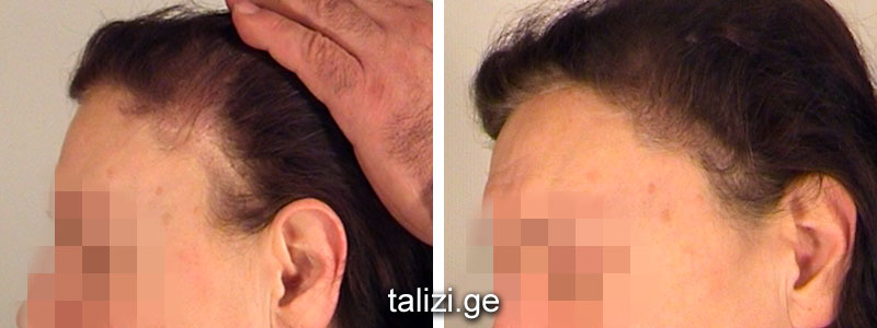 women scar hair treatment results