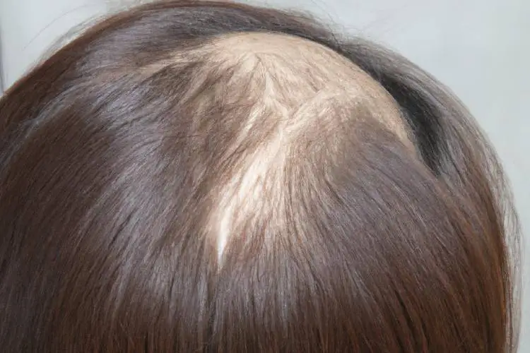 Hair loss during pregnancy: Causes and treatment options